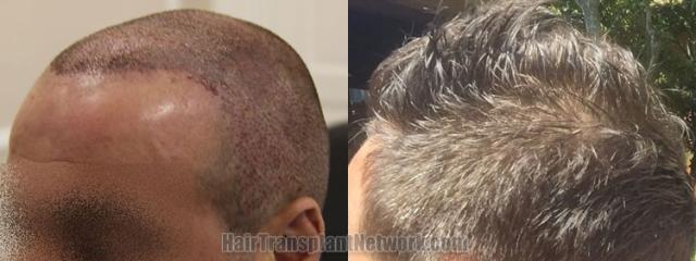 Hair transplantation surgery before and after images