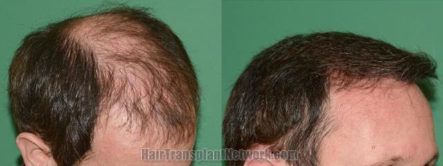 Hair transplantation surgery before and after images