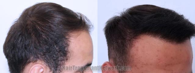 Hair transplantation surgery before and after images