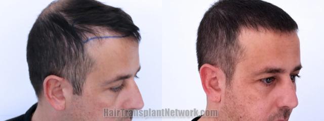 Hair transplantation surgery before and after images