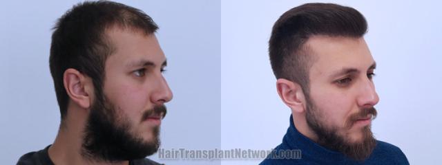 Hair transplantation surgery before and after images