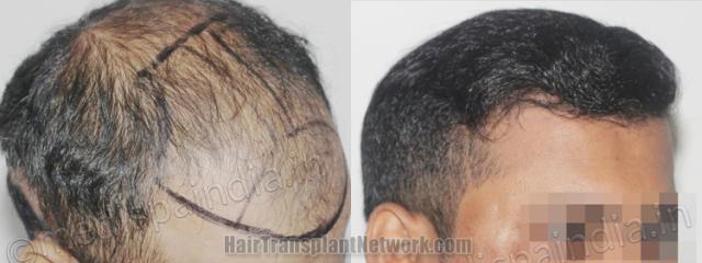 Hair transplantation surgery before and after images