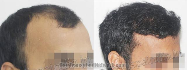 Hair transplantation surgery before and after images