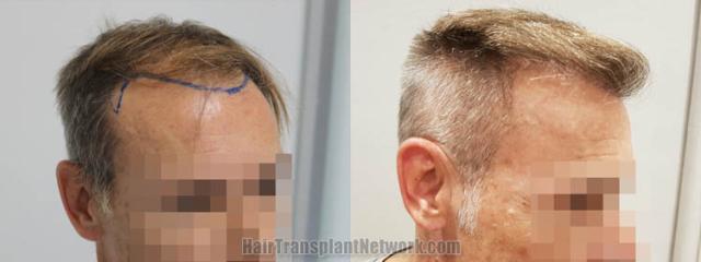 Hair transplantation surgery before and after images