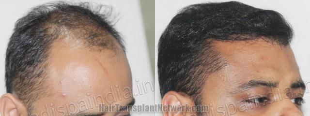 Hair restoration procedure before and after pictures