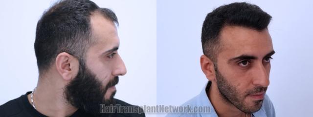 Hair transplantation surgery before and after images