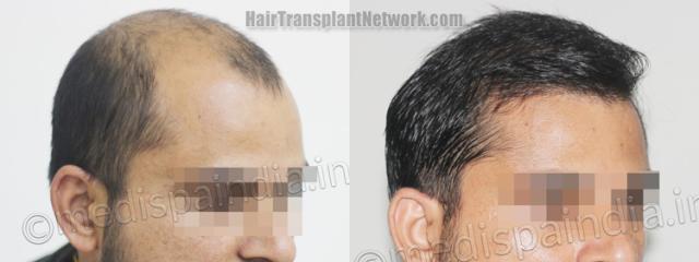 Hair transplantation surgery before and after images