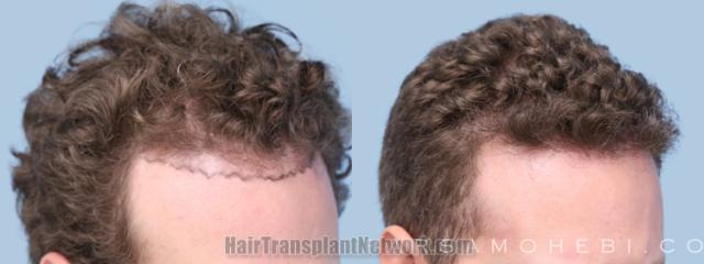 Hair transplantation surgery before and after images