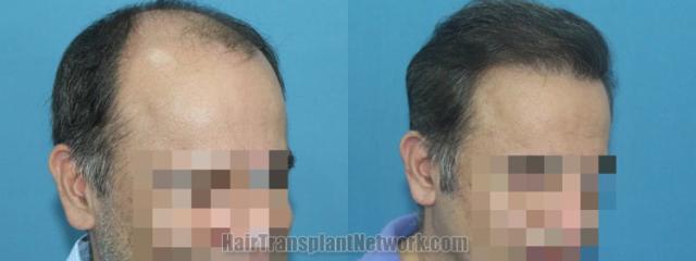 Hair transplantation surgery before and after images