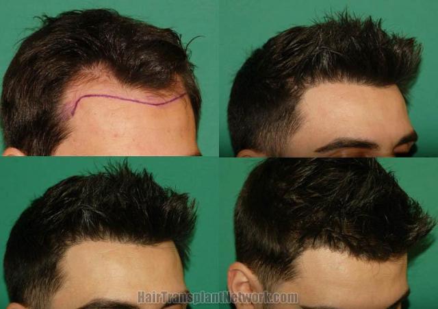 Hair transplantation procedure before and after results