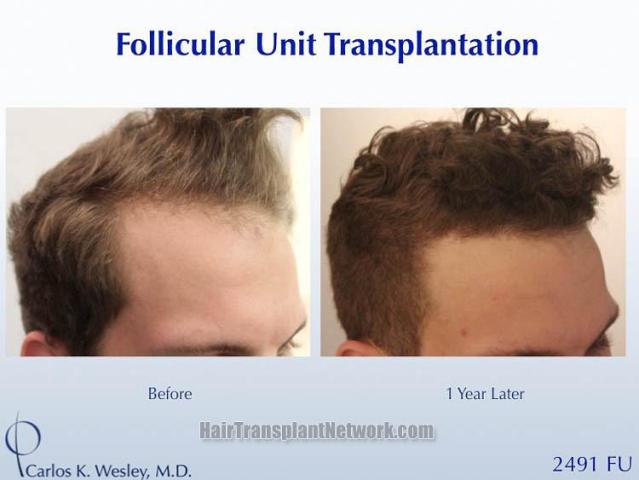 Hair transplantation procedure before and after results