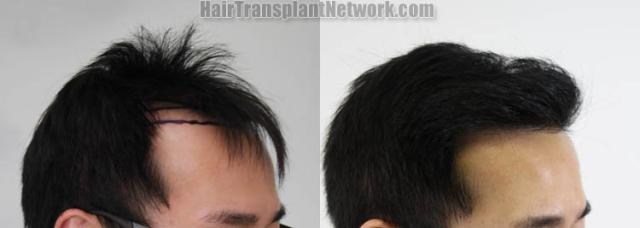 Hair restoration procedure before and after result images