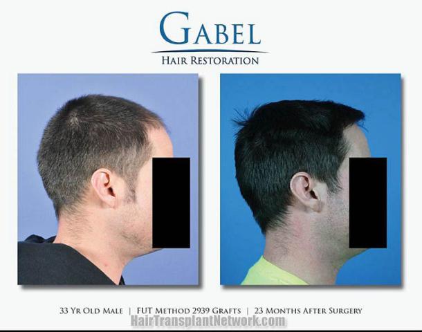 Hair transplantation procedure before and after results