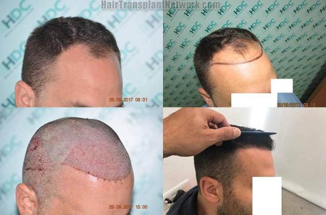 Hair restoration procedure after result images