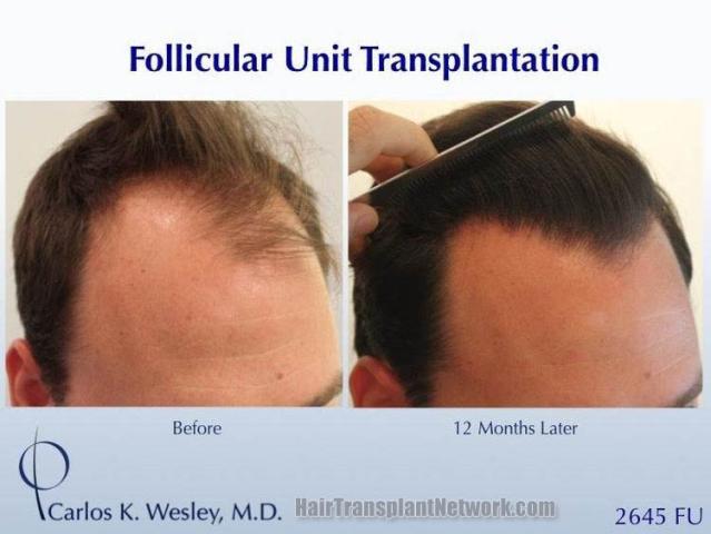 Hair transplantation procedure before and after results