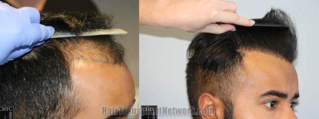 Hair transplantation surgery before and after images