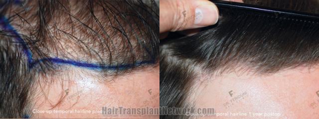 Hair transplantation surgery before and after images