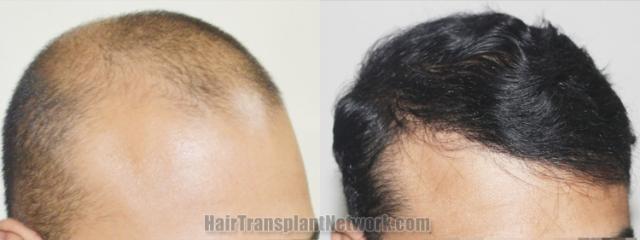 Hair transplantation surgery before and after images