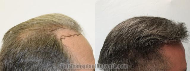 Hair transplantation surgery before and after images