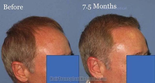 Hair transplantation surgery before and after photos