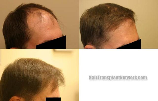 Hair restoration procedure before and after results