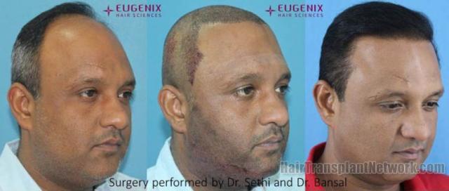 Hair transplantation procedure before and after results