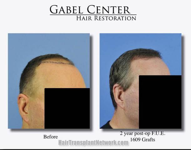 Hair transplantation surgery before and after pictures