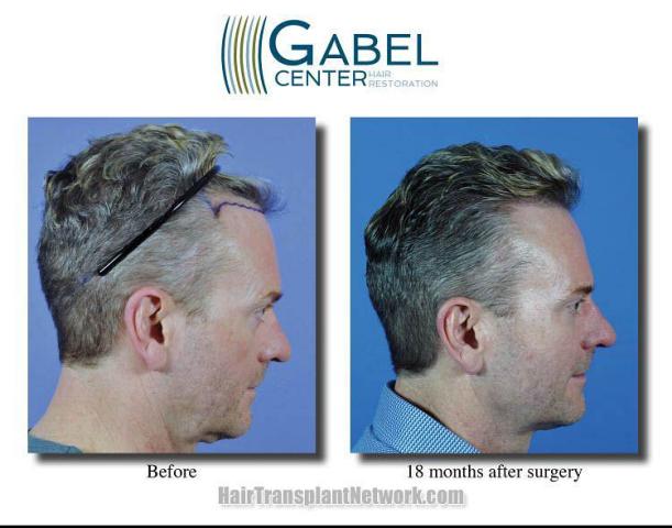 Hair restoration surgery before and after images