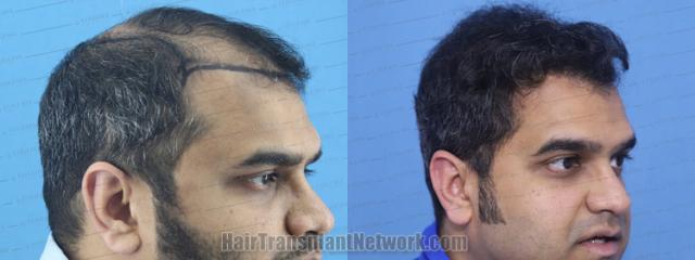  before and after result photographs