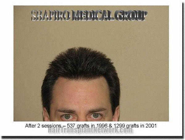 Hair restoration procedure results