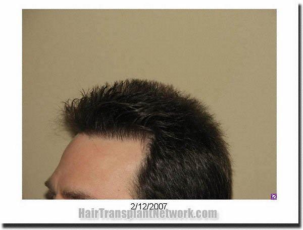 Hair restoration procedure results