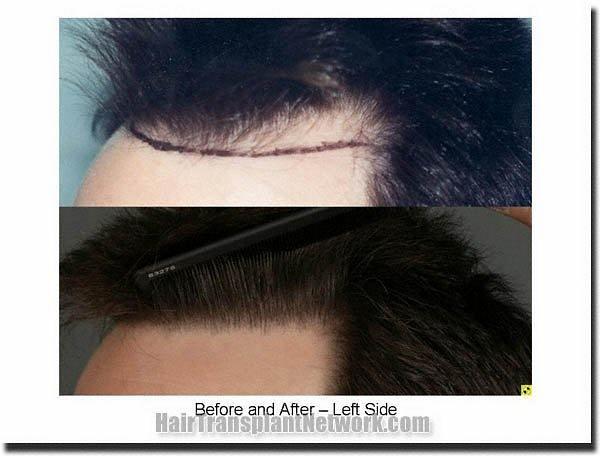 Hair restoration procedure results