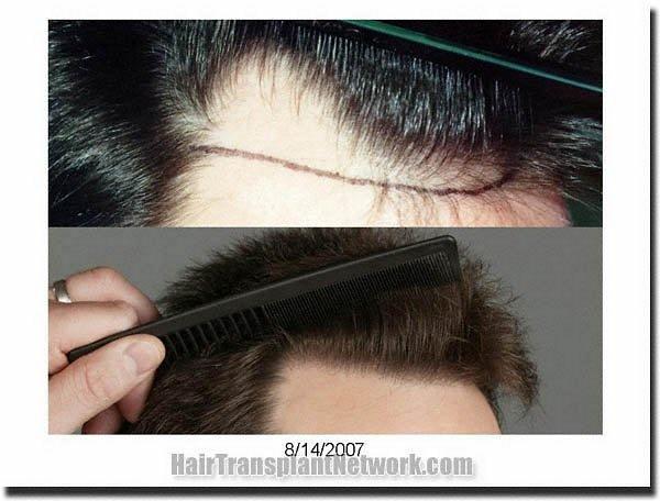 Hair restoration procedure results