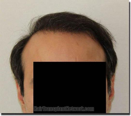 Hair restoration procedure results