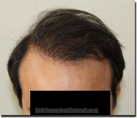 Hair restoration procedure results