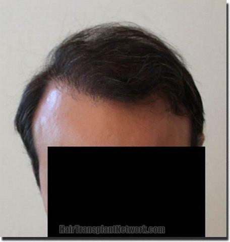 Hair restoration procedure results