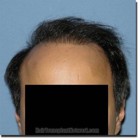 Hair restoration procedure results