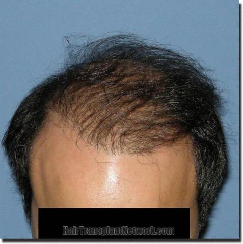 Hair restoration procedure results