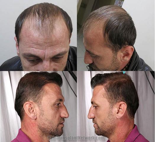 Hair restoration surgery before and after photographs