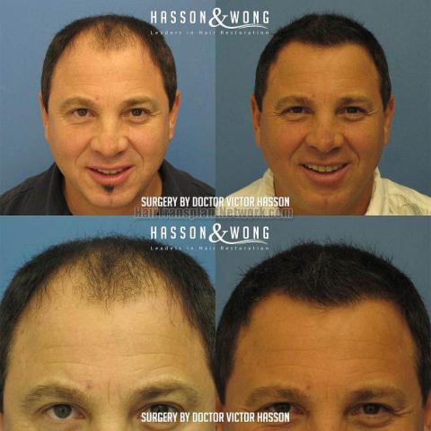 Front view - Before and after hair transplant surgery