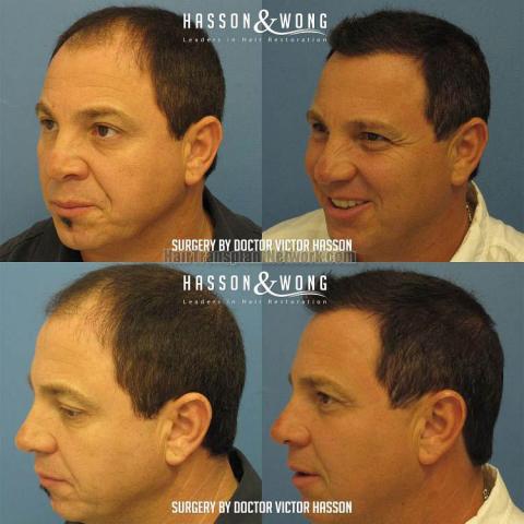 Hair transplantation surgery before and after images