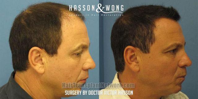 Hair restoration procedure before and after results