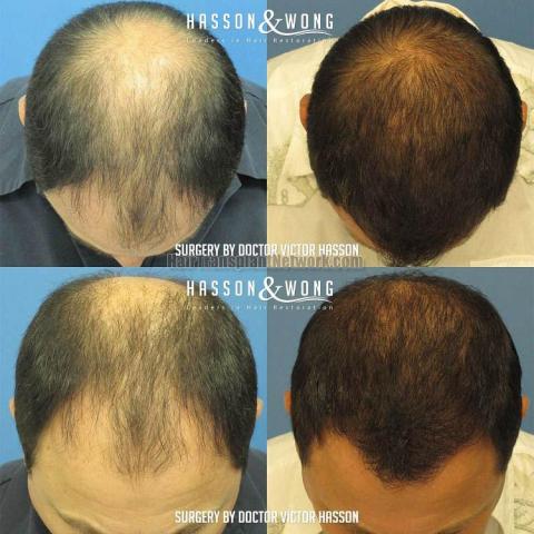 Before and after hair transplantation result photographs