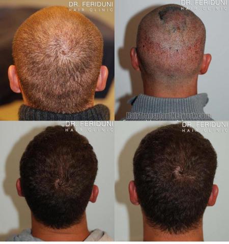 Hair transplantation surgery before and after photos