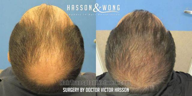 Surgical hair transplantation result photographs