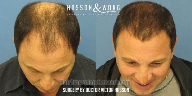 Before and after hair restoration procedure images