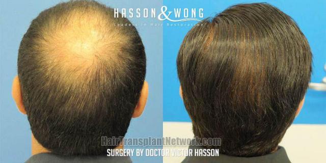 Hair transplant surgery before and after photos