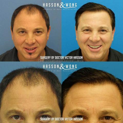 Hair transplant surgery before and after pictures