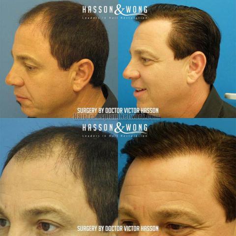 Hair transplant surgery before and after images