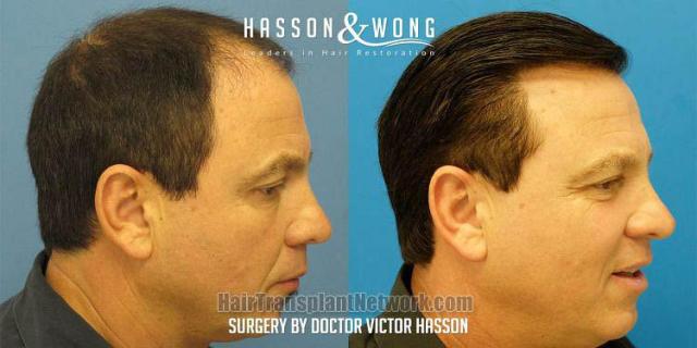 Hair transplant surgery before and after pictures